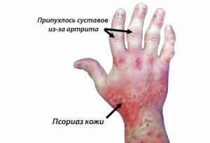 Psoriazinės artropatijos simptomai