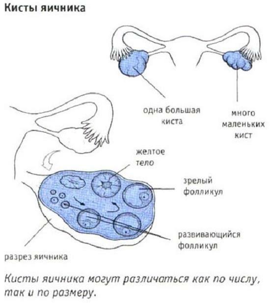 Kista ovarium