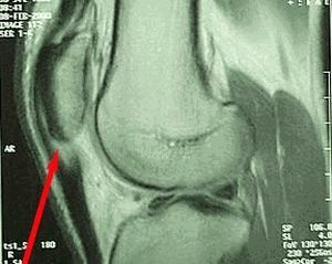 mgr of knee joint