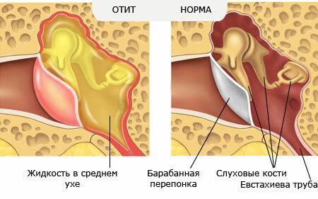 Otitis media of middle ear