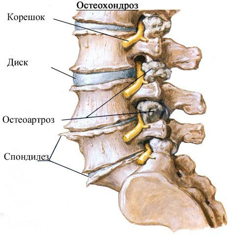 Osteochondróza