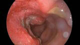 Cancro dell'intestino e sua diagnosi