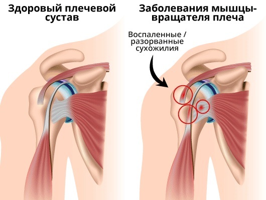 Shoulder tendon rupture. Treatment after surgery with folk remedies, symptoms, how it heals
