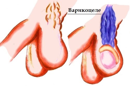 Características da varicocele na segunda fase do seu desenvolvimento