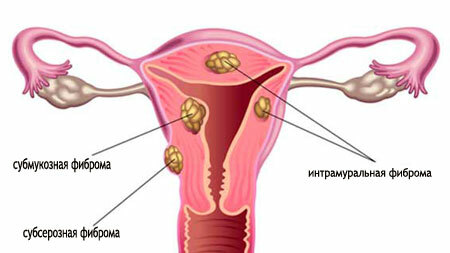 Fibroids av livmoren - tegn, symptomer og behandling, prognose