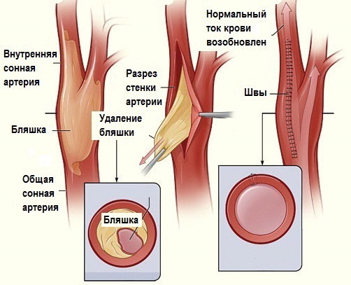 Arterije glave in vratu. Anatomija, diagram z opisom