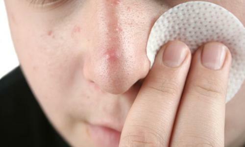Spuogai ant nosies: priežastys moterims
