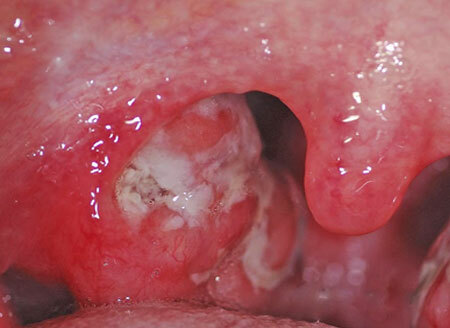 Foto della gola con angina follicolare