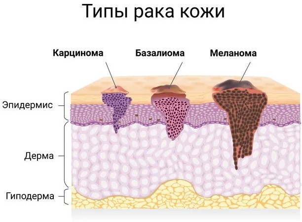 Basalioom op de neus. Foto, behandeling, cytologische foto