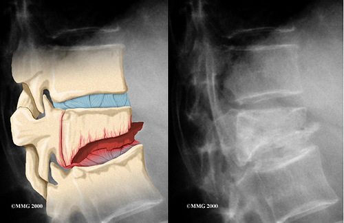 Frattura di compressione della colonna vertebrale toracica, sintomi e trattamento