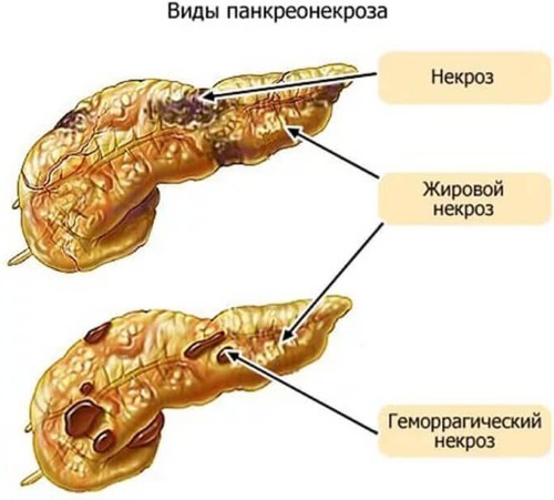 Pancreas enlargement. Causes, symptoms, treatment