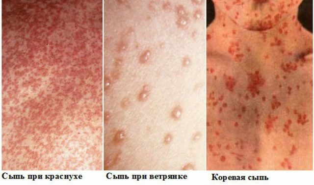 Comparison of rash with measles, chicken pox, rubella