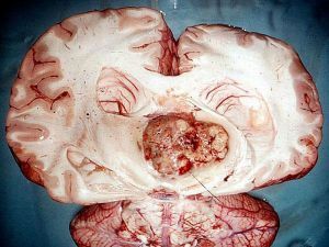 Tumeur dans le cerveau
