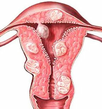 Uterin fibroids og graviditet