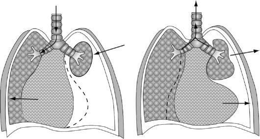 Esquema do pneumotórax aberto