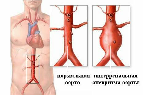 Anevrismul aortei abdominale