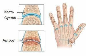 Development of arthrosis of the fingers