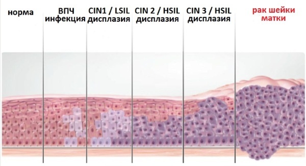 Proliferation of columnar epithelium. What is it, treatment, reasons before menstruation, during menopause, menopause, pregnancy, after childbirth