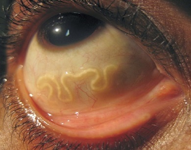Det nedre øyelokket er hovent og barnets øye gjør vondt
