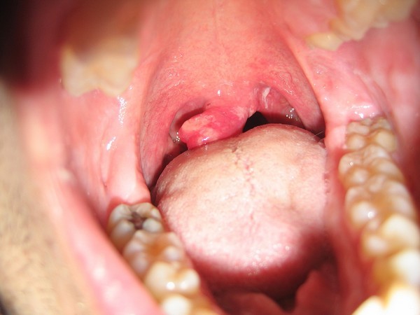 Hævelse af tungen i halsen. Hvad skal man gøre efter opkastning, tonsillitis, fjernelse af tonsiller, alkohol, grunde til, hvordan man fjerner en tumor