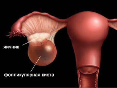 Behandeling van folliculaire ovariumcyste met folk remedies