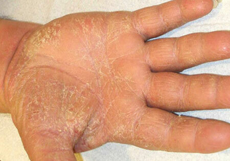 Rokas ekzēmas simptomi