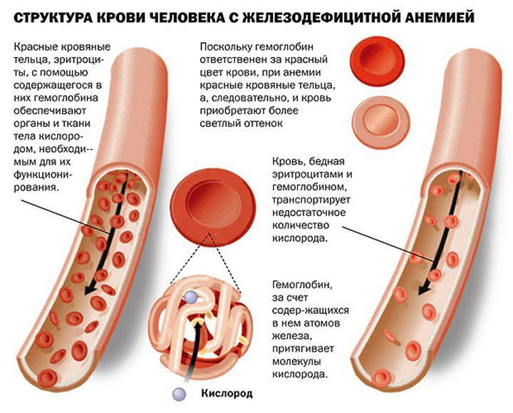 Struktura krve při anémii s nedostatkem železa