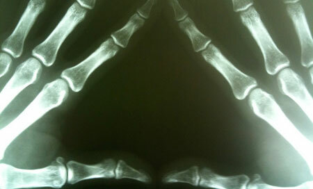 Zeichen der rheumatoiden Arthritis der Hände