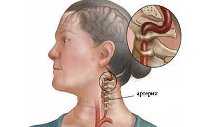 Syndrome of the vertebral artery