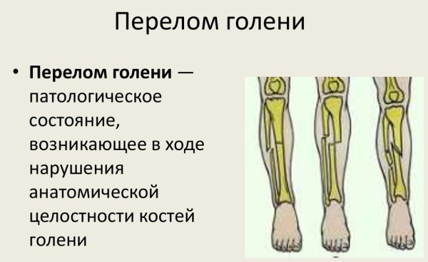 Inflammation of the periosteum of the lower leg when running. Treatment