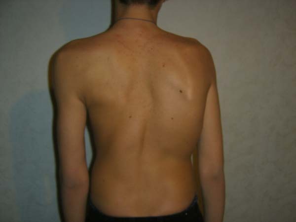 S-shaped scoliosis - photo