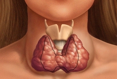 De meest verschrikkelijke gevolgen van auto-immune thyroiditis