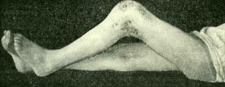 Fistulė su kelio sąnario tuberkulioze