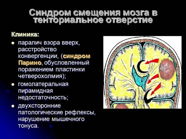 Přemístění mozku do tentorálního prostoru