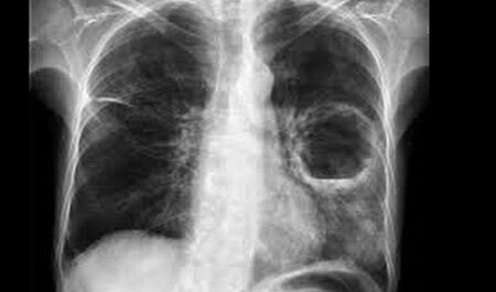 Diagnóstico de abscesso pulmonar