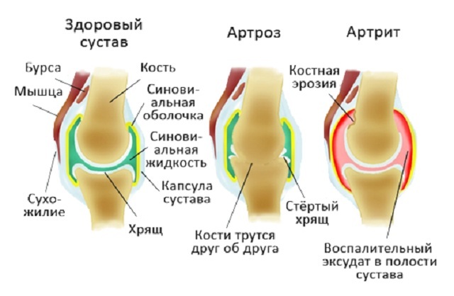 Artritida a artróza
