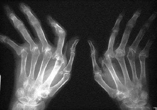 X-ray of rheumatoid polyarthritis