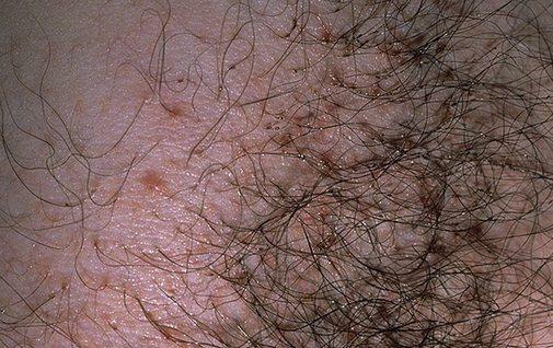 Infection with pubic peliculosis