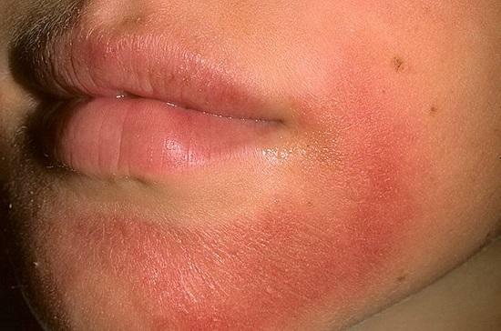 Allergic dermatitis on the face