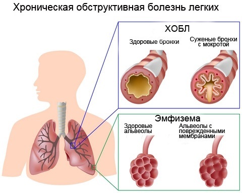 Forverring av kronisk bronkitt. Behandling, symptomer