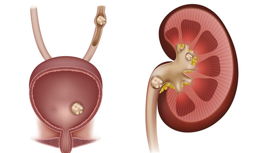 Types of kidney stones and methods of their treatment