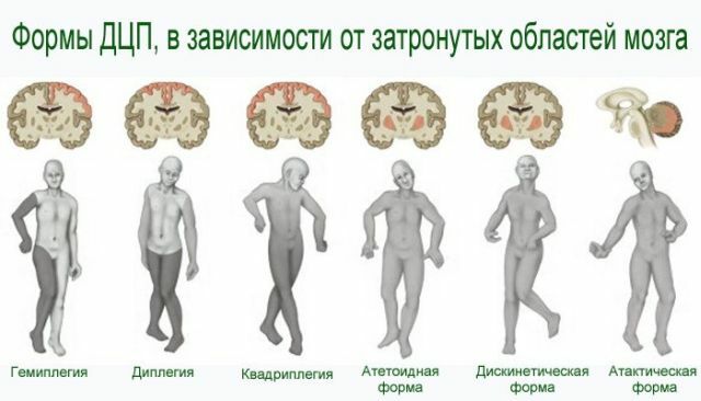 Dažādu smadzeņu paralīzes formu un veidu un to īpašību klasifikācija