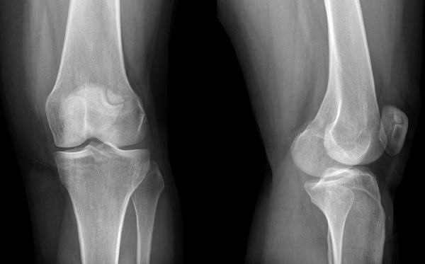 Primary gonarthrosis of the bilateral knee joint. What is it, symptoms, treatment