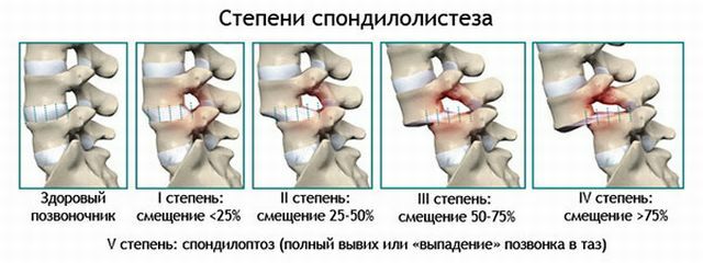 Spondiloliza și spondilolisteza coloanei vertebrale lombare