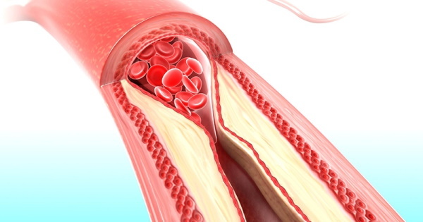 Cardiopatia ischemica. Sintomi e trattamento, farmaci, rimedi popolari