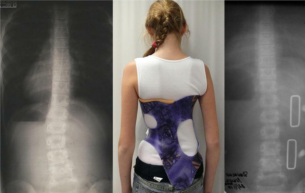 Scolioza de gradul 2, tratament cu corsete