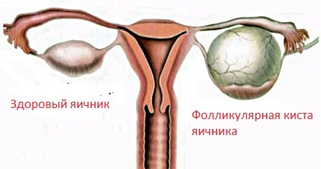 Chistul ovarian folicular