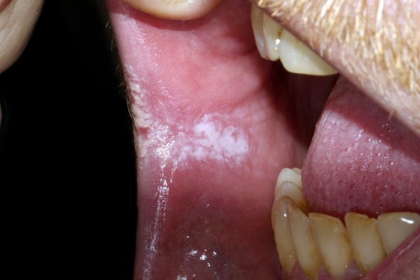 Leucoplasia da cavidade oral. Foto, diagnóstico diferencial
