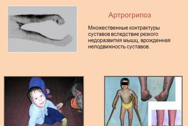 Arthrogryposis: alvorlig medfødt dysfunktion i leddene
