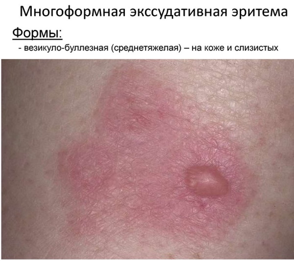 Erythema multiforme exudative. Differential diagnosis, treatment